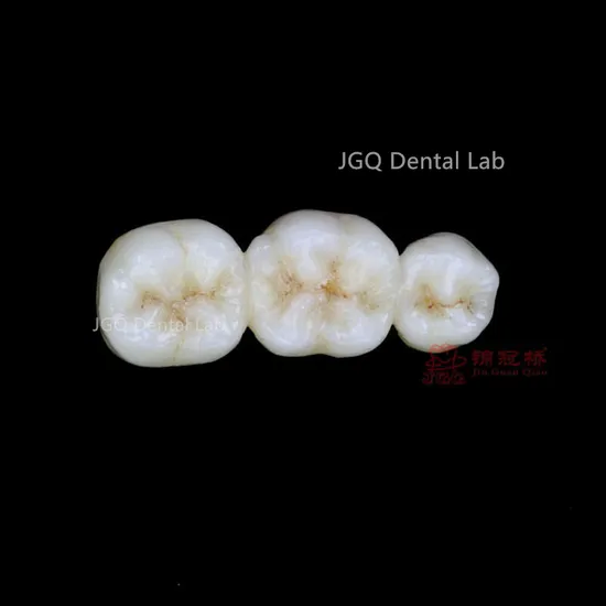 Orthodontics Treatment Dental All Ceramic Crown Made in Jgq Dental Lab in Guangzhou China